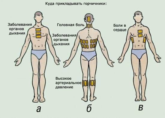 правильная постановка горчичников