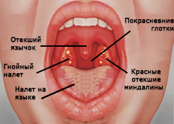 Симптомы гнойной ангины