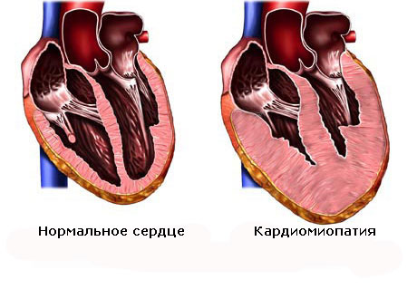 Сравнение размеров сердца